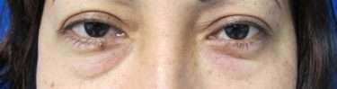 Eyelid Surgery Before & After Patient #8469