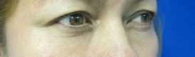 Eyelid Surgery Before & After Patient #8475