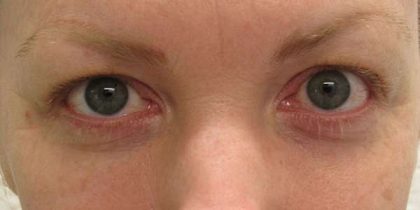 Eyelid Surgery Before & After Patient #8478