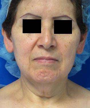 Facelift Before & After Patient #8492