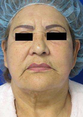 Facelift Before & After Patient #8508