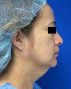Facelift Before & After Patient #8511
