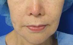 Facelift Before & After Patient #8514