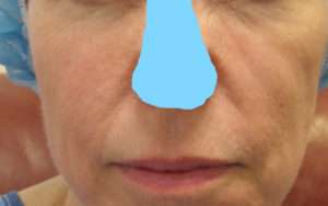Facelift Before & After Patient #8517