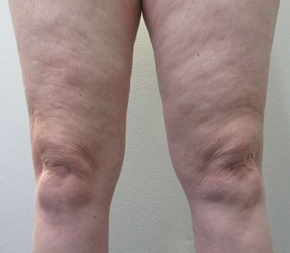 Bodytite Before & After Patient #6141