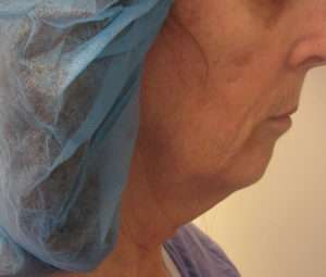 Facelift Before & After Patient #8527