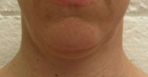 Facelift Before & After Patient #8534