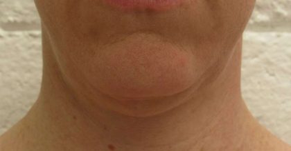 Facetite Before & After Patient #8541
