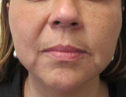 Facetite Before & After Patient #8546