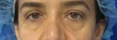 Facial Fat Grafting and Stem Cell Rejuvenation Before & After Patient #8557