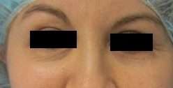 Facial Fat Grafting and Stem Cell Rejuvenation Before & After Patient #8560