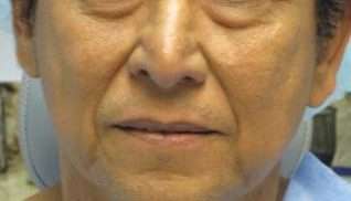 Facial Fat Grafting and Stem Cell Rejuvenation Before & After Patient #8563