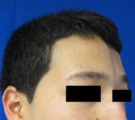 Facial Fat Grafting and Stem Cell Rejuvenation Before & After Patient #8566