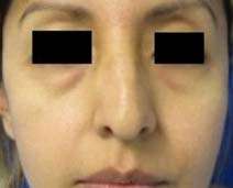 Facial Fat Grafting and Stem Cell Rejuvenation Before & After Patient #8569