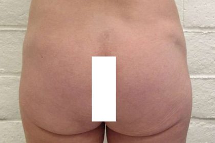 Fat Necrosis and Dead Fat Removal Before & After Patient #8576