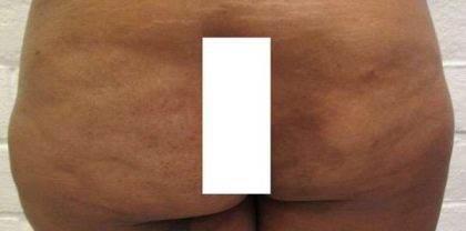 Fat Necrosis and Dead Fat Removal Before & After Patient #8579