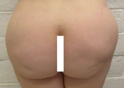 Fat Necrosis and Dead Fat Removal Before & After Patient #8586