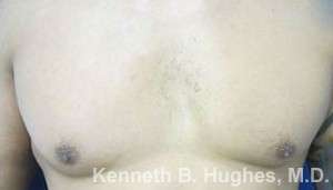 Gynecomastia Before & After Patient #8609