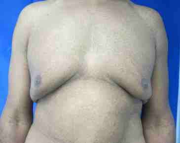 Gynecomastia Before & After Patient #8612