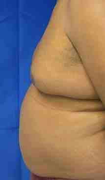 Gynecomastia Before & After Patient #8616