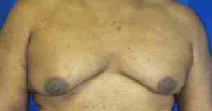 Gynecomastia Before & After Patient #8619
