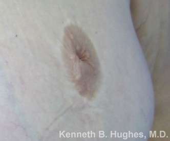 Inverted Nipple Correction Before & After Patient #8628