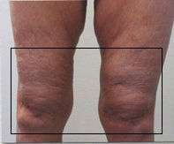 Knees Before & After Patient #8637