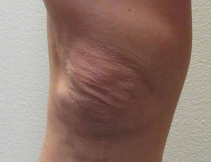 Knees Before & After Patient #8642