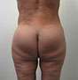 Bodytite Before & After Patient #6152