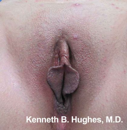 Labial Rejuvenation Before & After Patient #8663