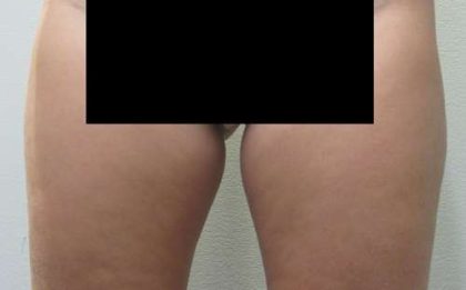 Bodytite Before & After Patient #6155