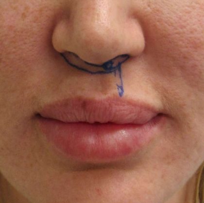 Lip Lift Before & After Patient #8675