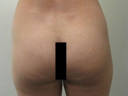 Liposuction Before & After Patient #8696