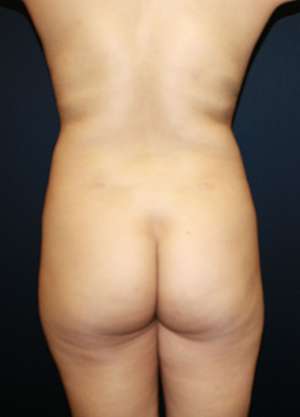 Liposuction Before & After Patient #8727