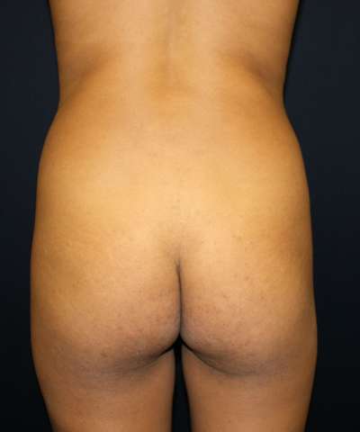Liposuction Before & After Patient #8739