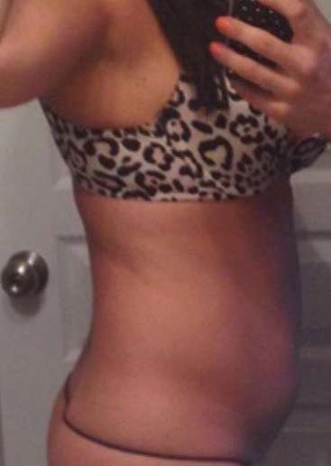 Liposuction Before & After Patient #8750