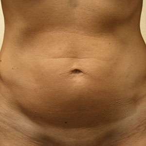 Abdomen Before & After Patient #5869