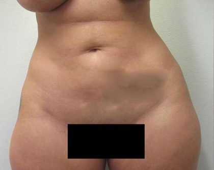 Liposuction Before & After Patient #8774