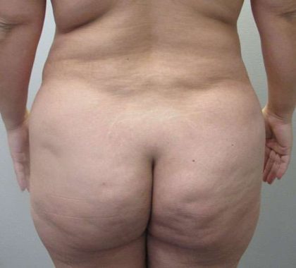 Liposuction Before & After Patient #8777