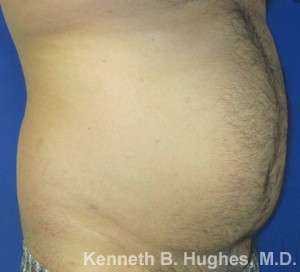 Liposuction Before & After Patient #8791