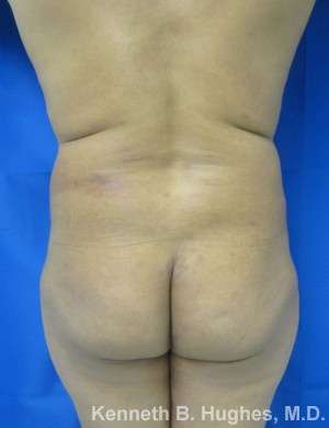 Liposuction Before & After Patient #8794