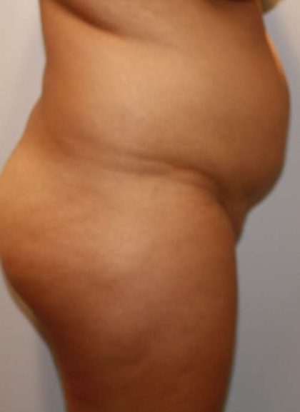 Liposuction Before & After Patient #8797