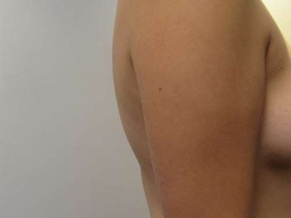 Bodytite Before & After Patient #6170