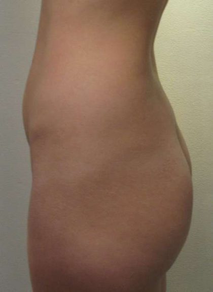 Liposuction Before & After Patient #8802