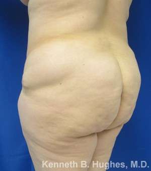 Liposuction Before & After Patient #8817