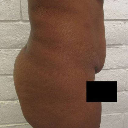 Liposuction Before & After Patient #8832