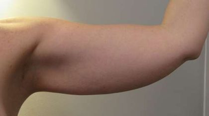 Bodytite Before & After Patient #6175