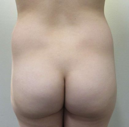 Liposuction Before & After Patient #8844