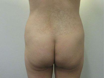 Liposuction Before & After Patient #8852