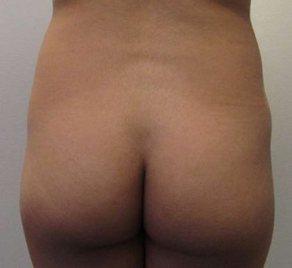 Liposuction Before & After Patient #8888